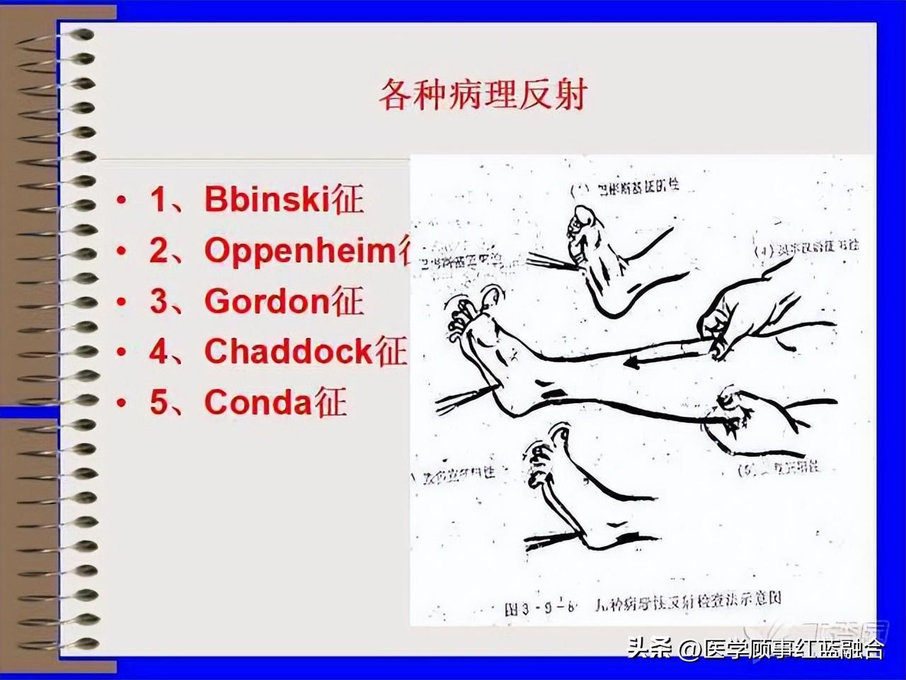 锥体束受损见于哪个疾病（oppenheim奥本海姆征）